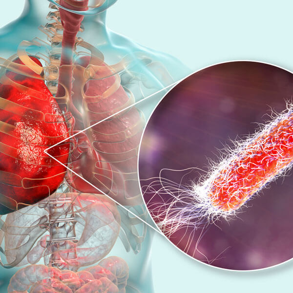 depiction of Legionella bacteria in a lung